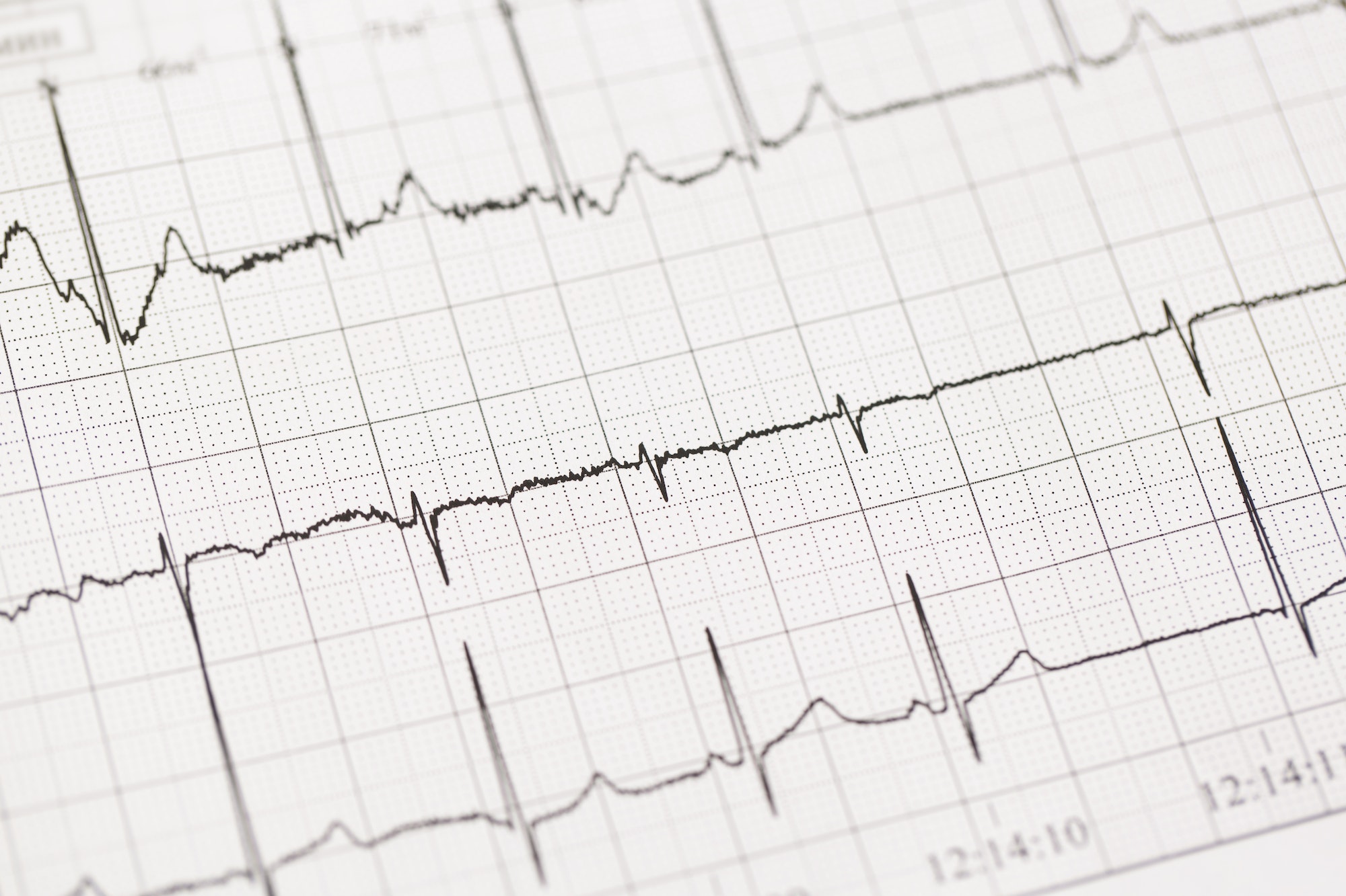 Using Practice EKG Strips To Improve Your ECG Interpretation