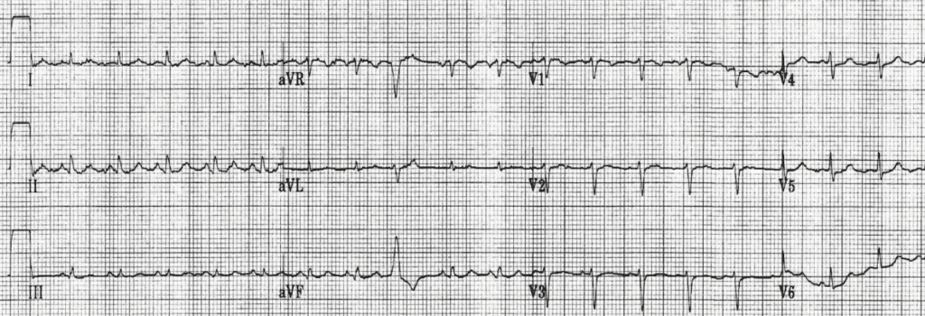 Practice ECG 1