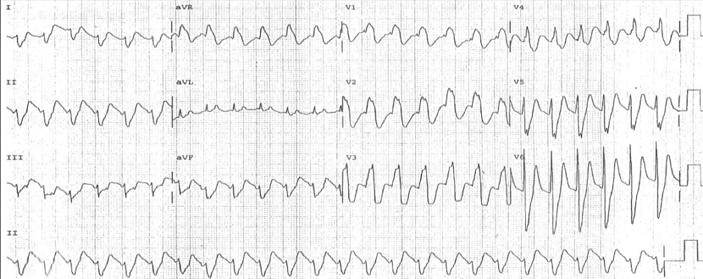 Practice ECG 11