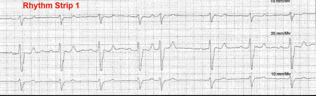 Practice ECG 12 - Rhythm Strip 1