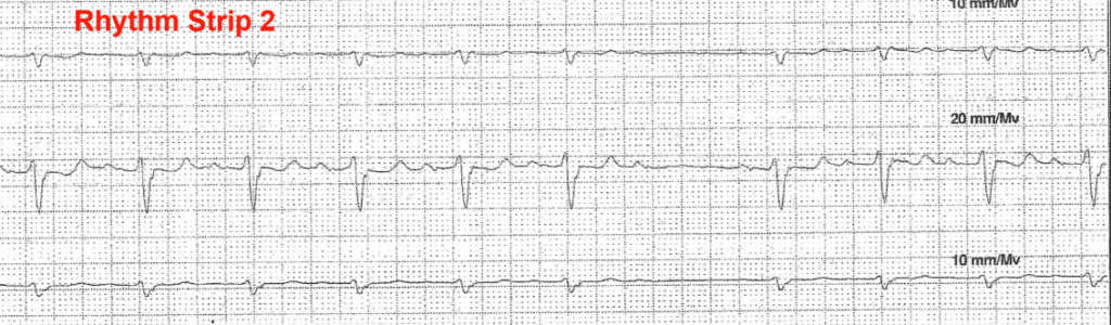 Practice ECG 12 - Rhythm Strip 2