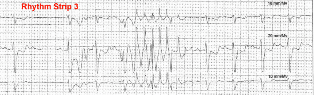 Practice ECG 12 - Rhythm Strip 3