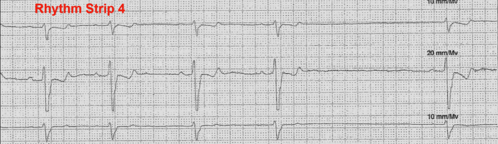 Practice ECG 12 - Rhythm Strip 4