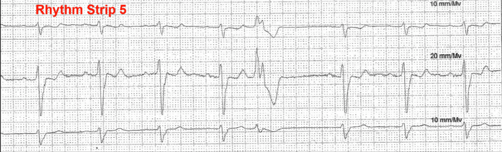 Practice ECG 12 - Rhythm Strip 5