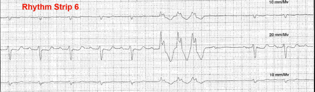 Practice ECG 12 - Rhythm Strip 6