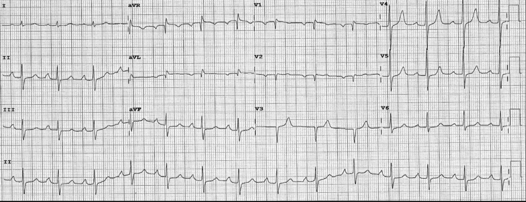 Practice ECG 13