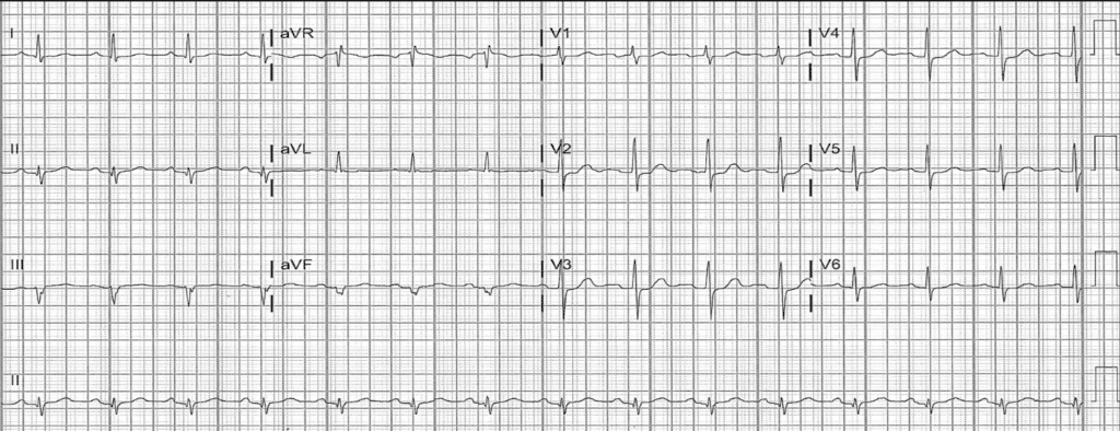 Practice ECG 14