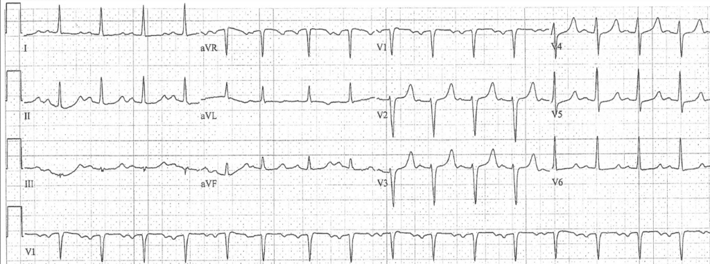 Practice ECG 15