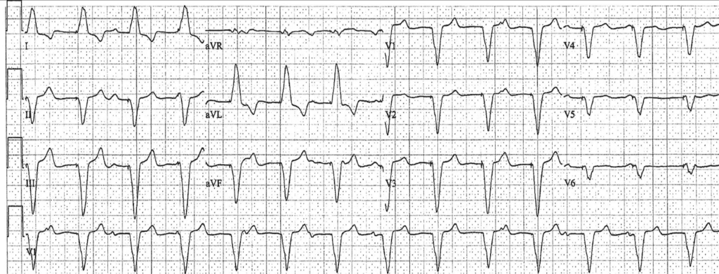 Practice ECG 16