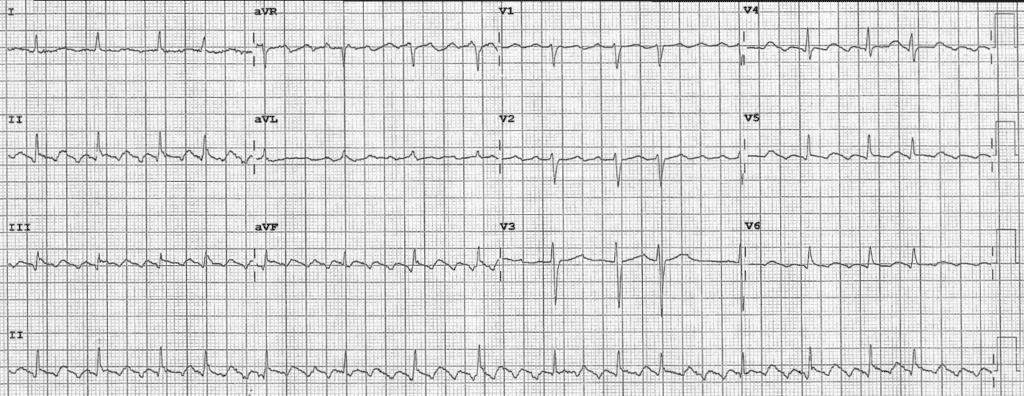 Practice ECG 17