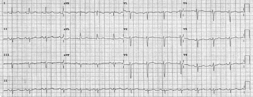 Practice ECG 18