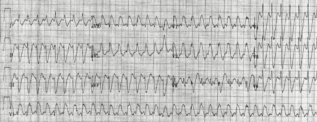 Practice ECG 2