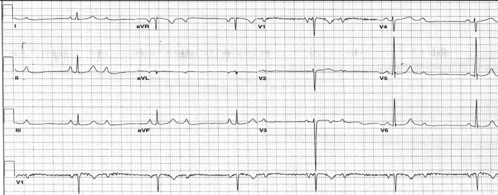 Practice ECG 20