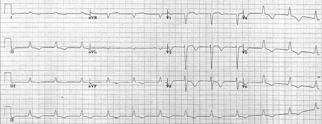 Practice ECG 22