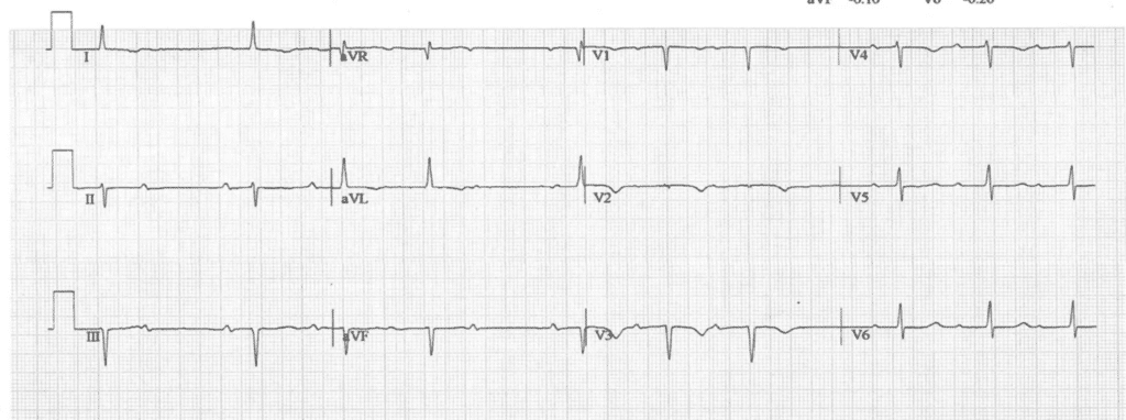 Practice ECG 23