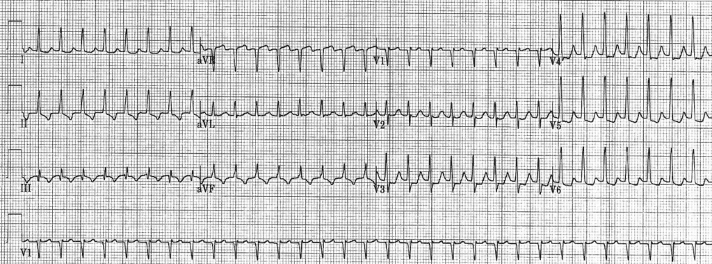 Practice ECG 25