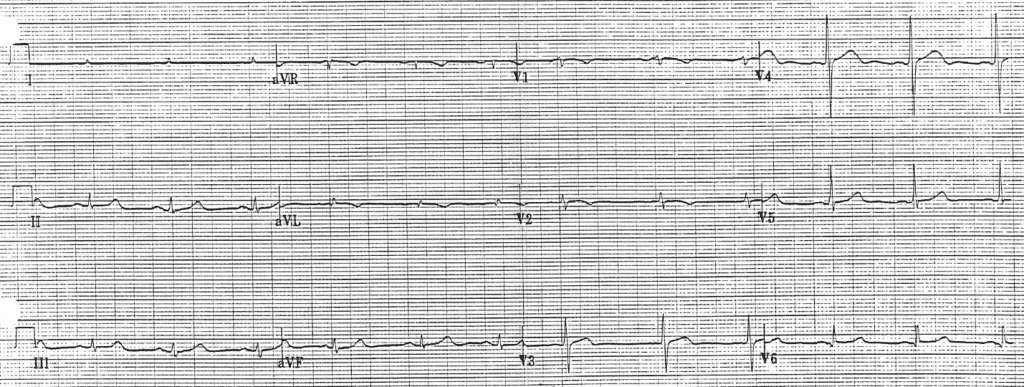 Practice ECG 26