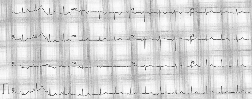 Practice ECG 27