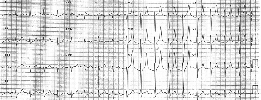 Practice ECG 28