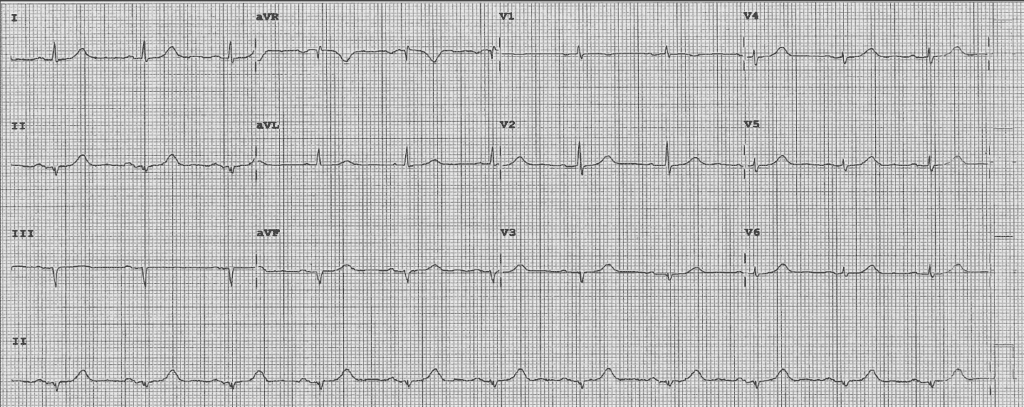 Practice ECG 29