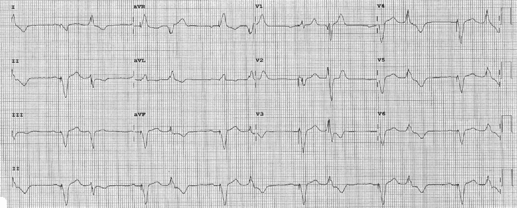 Practice ECG 30