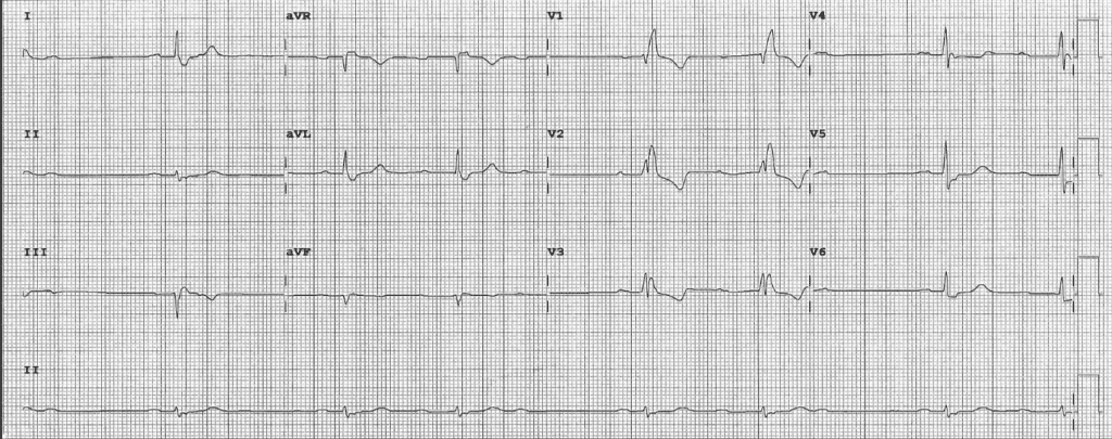 Practice ECG 31