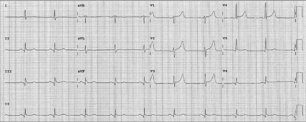 Practice ECG 32