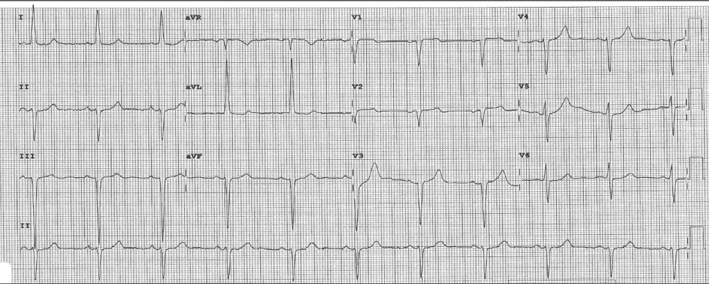 Practice ECG 33