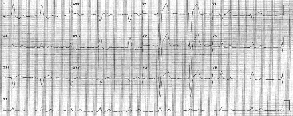 Practice ECG 34