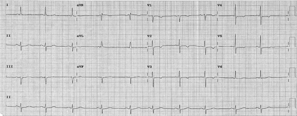 Practice ECG 35