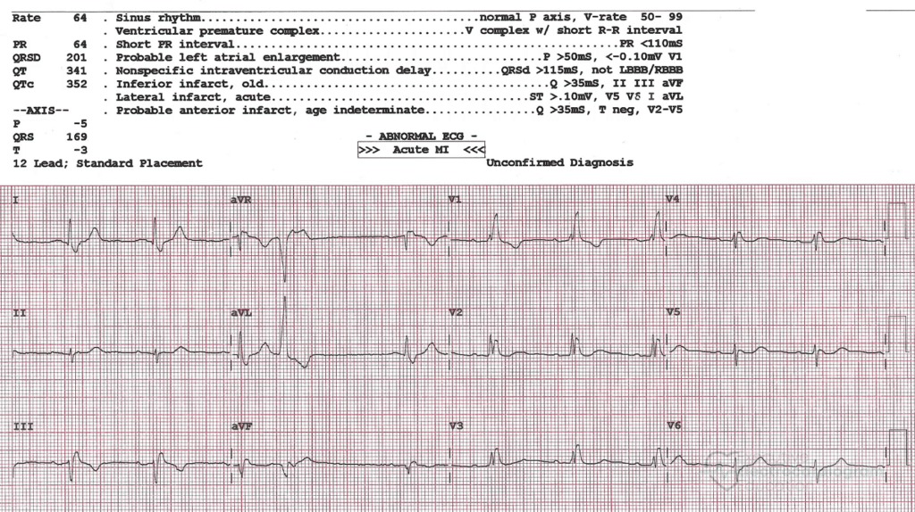 Practice ECG 36