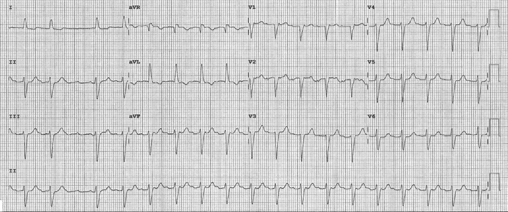 Practice ECG 37