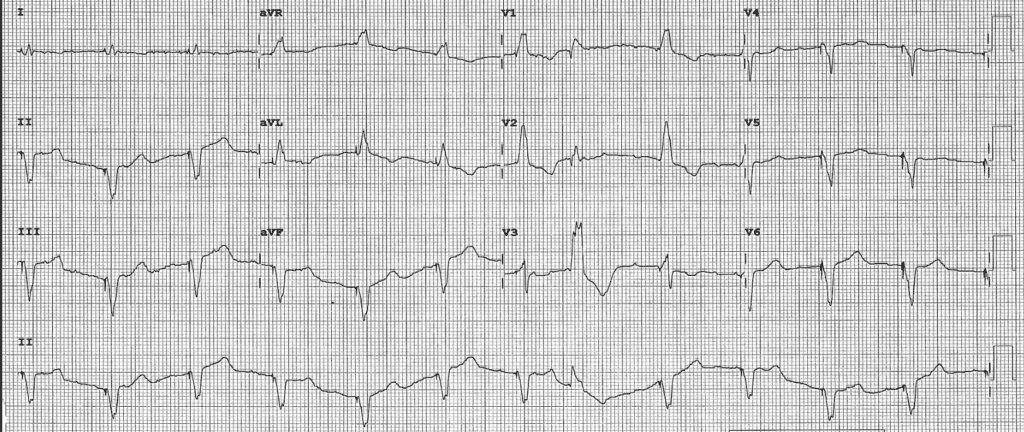 Practice ECG 38