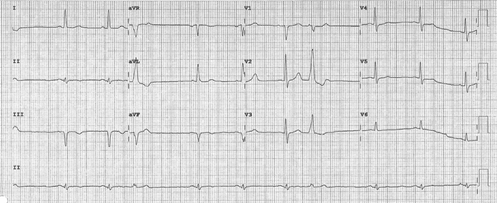 Practice ECG 39