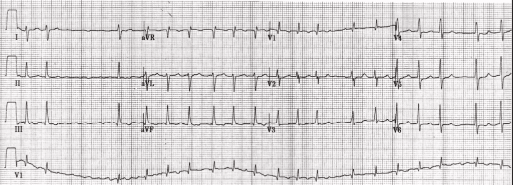 Practice ECG 4