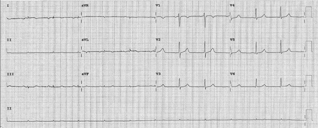 Practice ECG 40