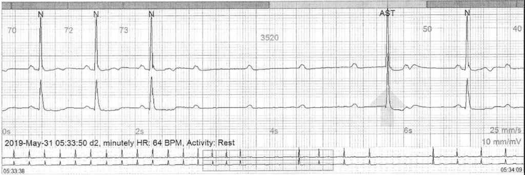 Practice ECG 5