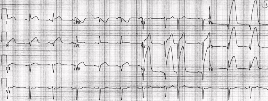 Practice ECG 6