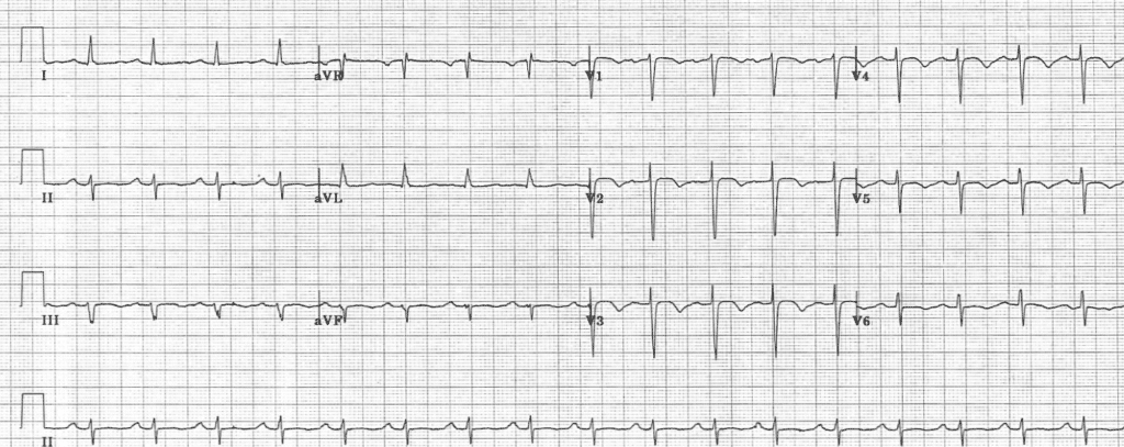 Practice ECG 8